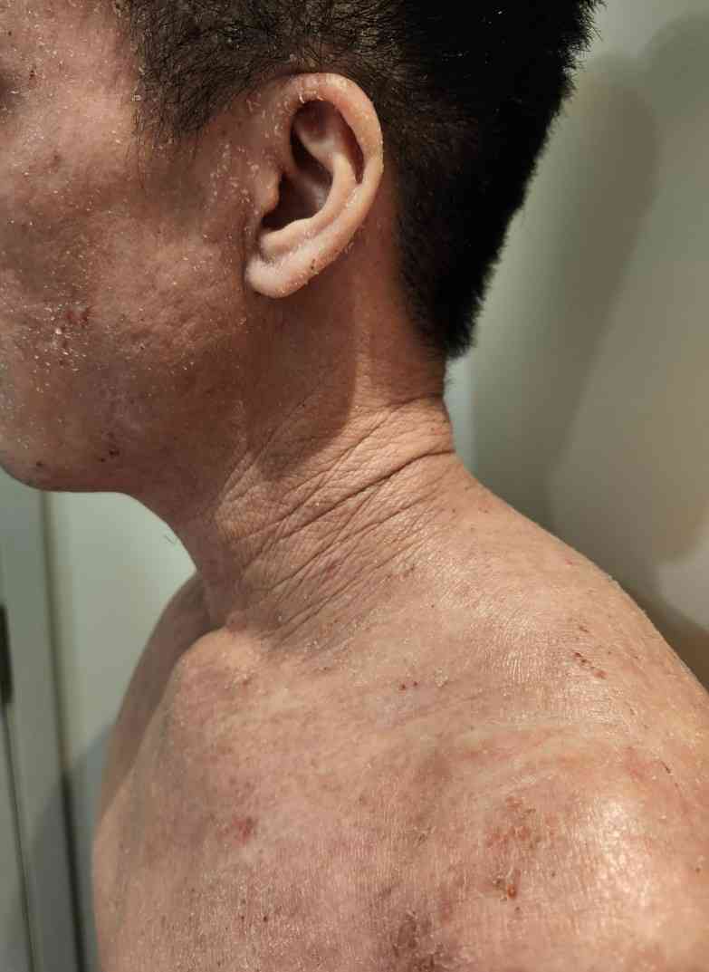 濕疹︱近九成受訪患者半年內曾復發，十年抗病歷程患者個案分享，最新濕疹治療趨勢