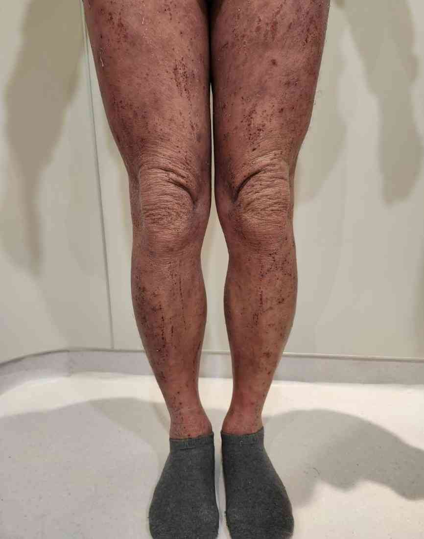 濕疹︱近九成受訪患者半年內曾復發，十年抗病歷程患者個案分享，最新濕疹治療趨勢