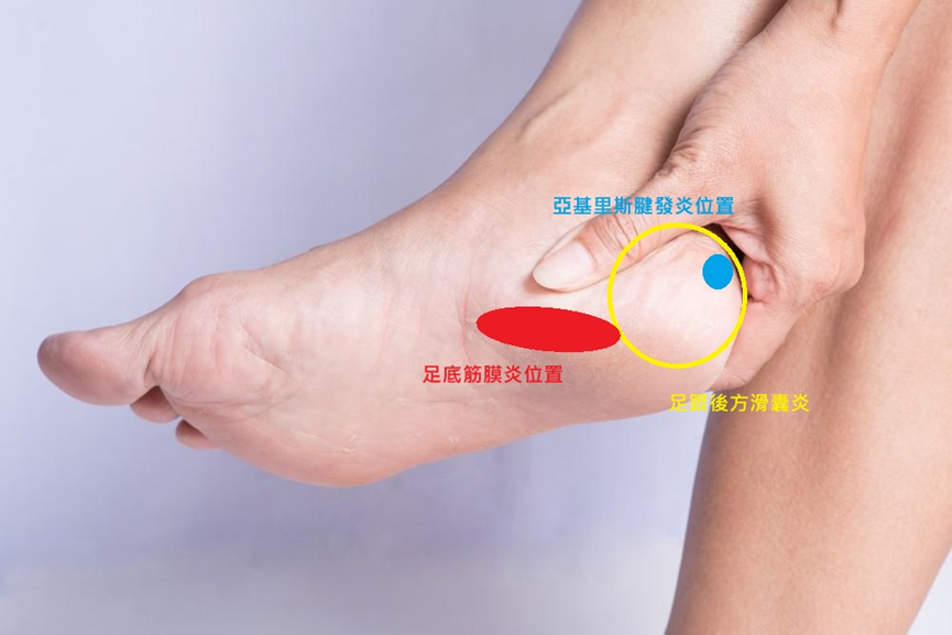 夏天穿涼鞋腳踭痛？急性足底筋膜疼痛處理＋穿防滑襪舒緩＋小腿拉筋伸展運動示範
