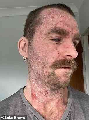 濕疹自救｜37歲男戒斷類固醇　全身爆嚴重濕疹險盲　臥床7個月靠「1飲品」養膚重生