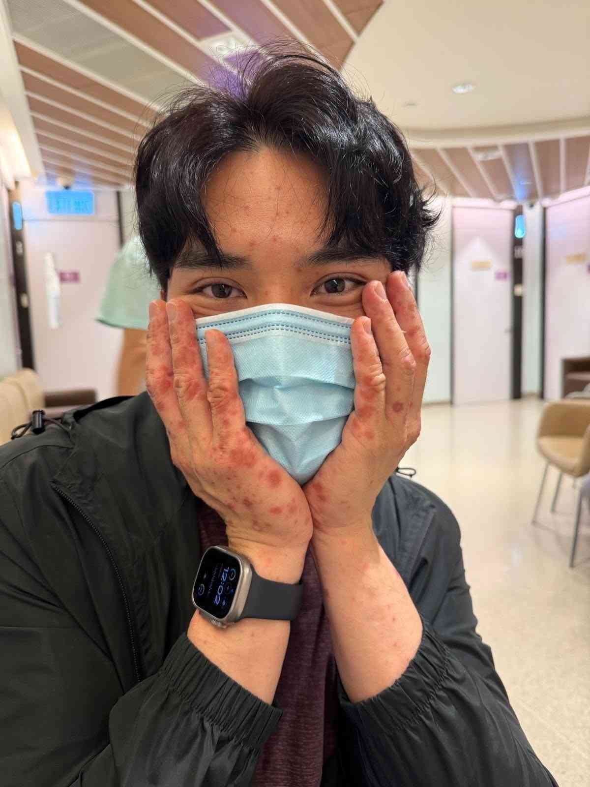 蚊叮蟲咬|《愛回家》風少陳浚霆歐遊行山出事 1原因全身爆紅疹極恐怖 險「毀容」急回港求醫【附皮膚科醫生夏日防蟲貼士】 蚊叮蟲咬|《愛回家》風少陳浚霆歐遊行山出事 1原因全身爆紅疹極恐怖 險「毀容」急回港求醫【附皮膚科醫生夏日防蟲貼士】