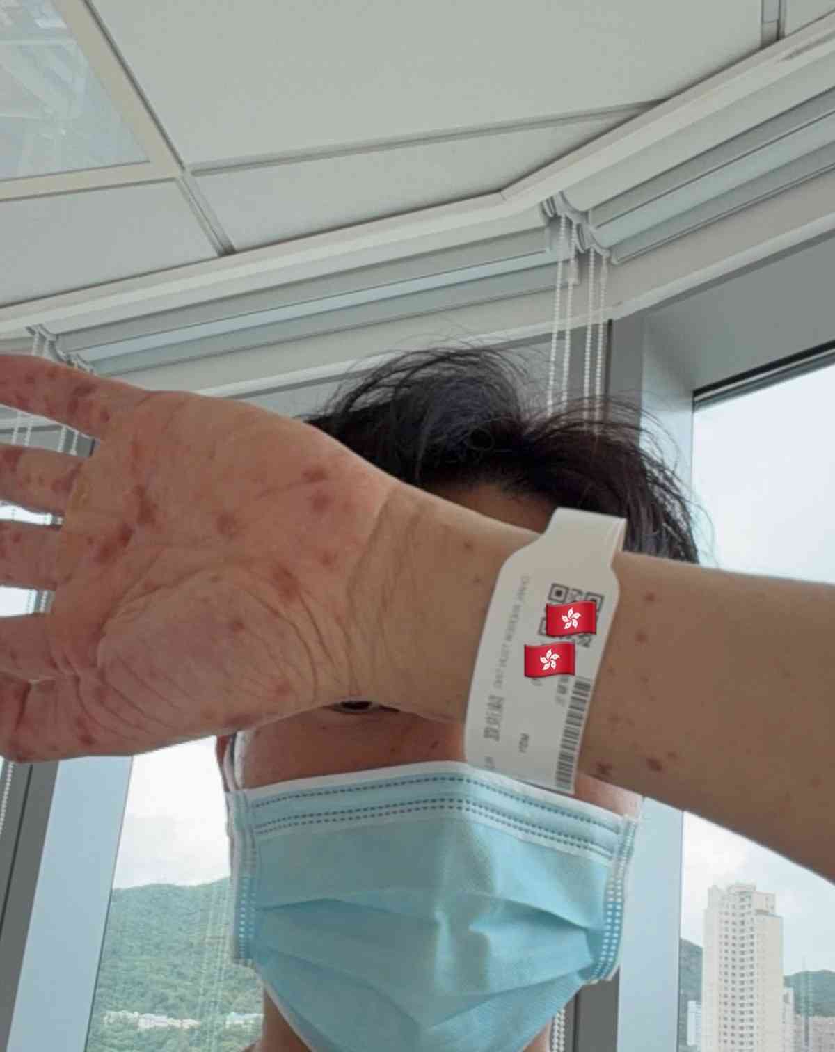 蚊叮蟲咬|《愛回家》風少陳浚霆歐遊行山出事 1原因全身爆紅疹極恐怖 險「毀容」急回港求醫【附皮膚科醫生夏日防蟲貼士】 蚊叮蟲咬|《愛回家》風少陳浚霆歐遊行山出事 1原因全身爆紅疹極恐怖 險「毀容」急回港求醫【附皮膚科醫生夏日防蟲貼士】