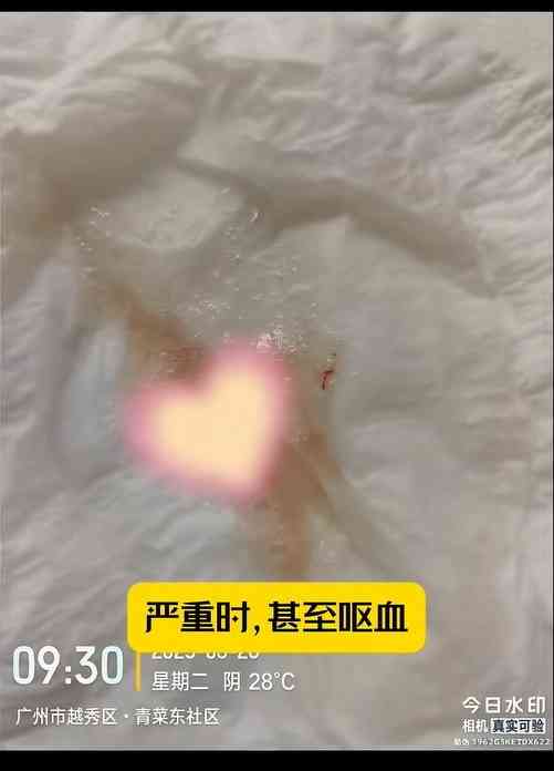 胃癌|23歲博士生寒窗苦讀16年確診胃癌晚期 歷22次化療暴瘦44磅 揭兩大習慣出事 胃癌|23歲博士生寒窗苦讀16年確診胃癌晚期 歷22次化療暴瘦44磅 揭兩大習慣出事