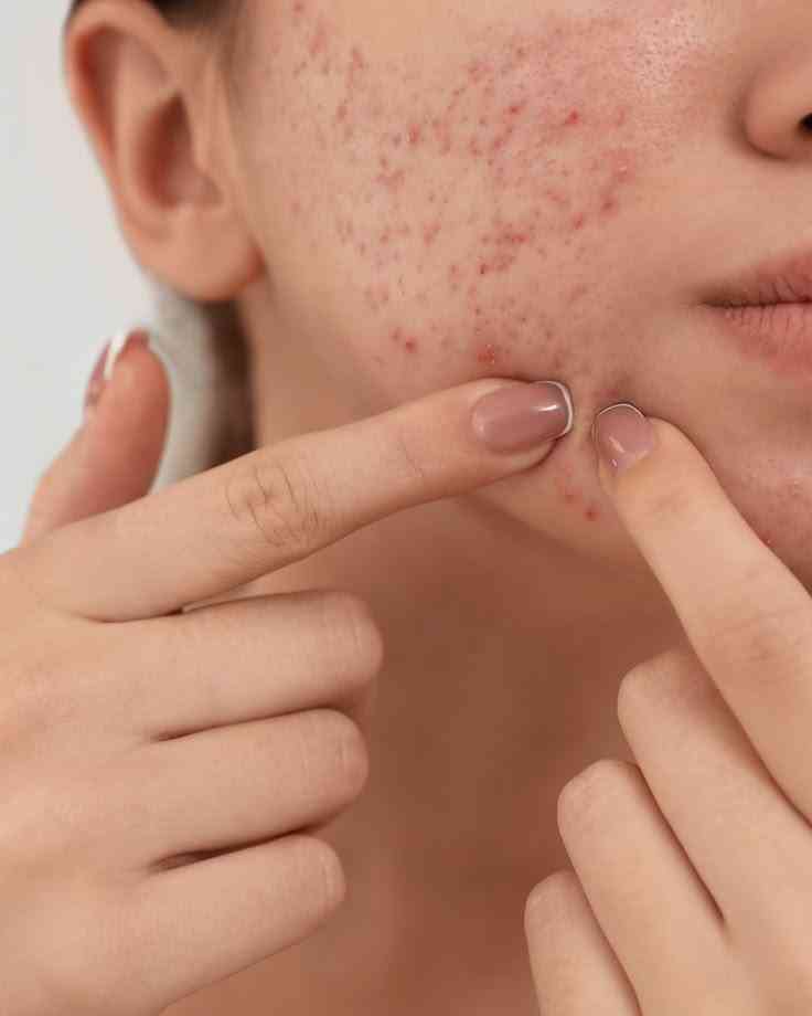 皮膚健康｜暗瘡反覆不斷？牛奶、甜食、乳清蛋白要留意　醫生推介5種食物改善膚況