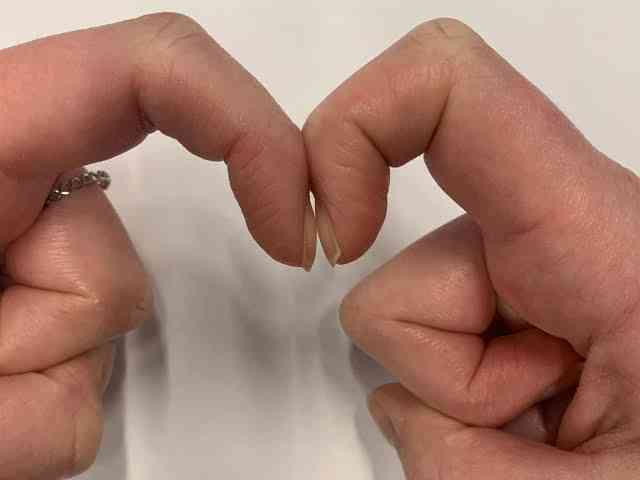 肺癌警號｜健身教練不吸煙亦無咳嗽氣促跡象  因指尖持續腫脹求醫揭患第3期肺癌