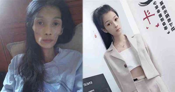抑鬱症|27歲女受連番打擊導致嚴重抑鬱，厭食症、胃萎縮，體重...