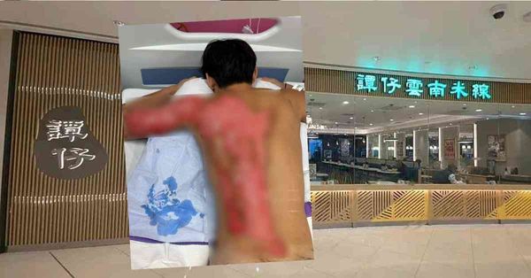 燙傷意外:譚仔熱水壺翻倒淋背，現役運動員背部大面積二級燙傷，...