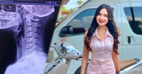 按摩致死 │ 20歲女星泰國按摩lock頸身亡，醫生拆解1個位置絕不能按的原因