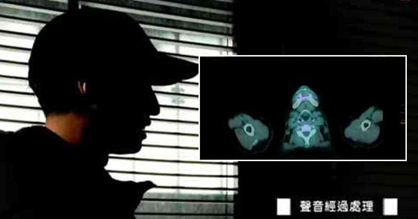 醫療失誤 │ 母親因胰臟癌手術流血不止逝世，家屬質疑人為錯誤，錄音顯示醫生承認失誤
