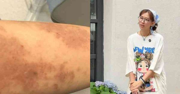 名人健康 │ 43歲前落選港姐自爆：好友騙財引爆免疫問題，全身爛肉暴瘦至70多磅
