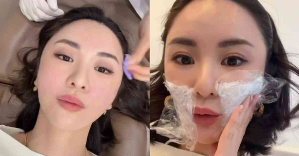 名人醫美 │ 37歲裕美韓國整容實況公開，術後3日真面目曝光...