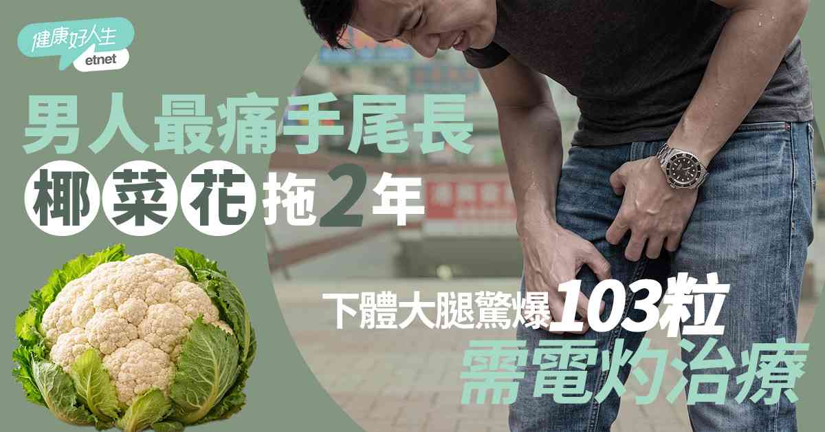 性病危機｜30歲男染椰菜花拖足2年，下體至大腿狂飆103粒，電灼治療清極都有