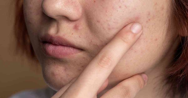 中醫運用八字、用神與忌神治療月經前痤瘡：半年反覆病例、飲食宜忌