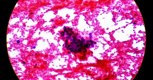 異動股｜康方生物高開9％，依沃西治肺癌成果獲ASCO肯定兼登《柳葉刀》