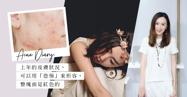 Acne Diary：持續8個月的苦戰，擺脫敏感暗瘡肌的真實經過