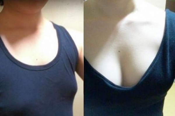 抽出脂肪不浪費 自體脂肪隆胸術